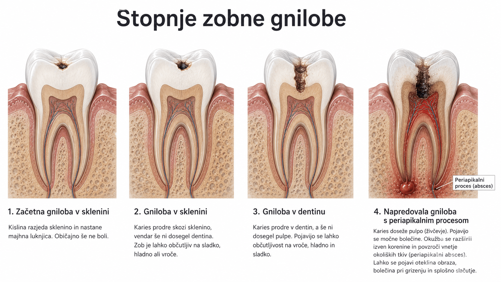 stadiji-zobne-gnilobe
